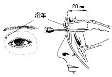 泪囊鼻腔吻合术图片