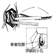 泪囊鼻腔吻合术图片