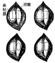 泪囊鼻腔吻合术图片