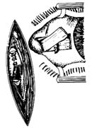 结膜囊鼻腔吻合术图片