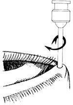 鼻泪管环切术图片