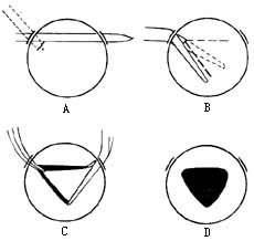 虹膜切除术图片