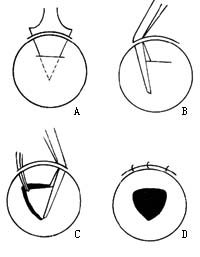 虹膜切除术图片