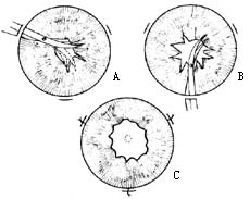 虹膜切开术图片