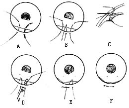 虹膜缝合术图片