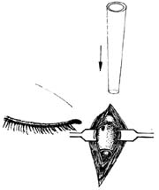 鼻泪管义管植入法图片