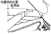 前房角切开术图片