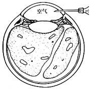 恶性青光眼的手术治疗图片