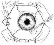 周边虹膜切除术图片