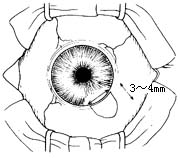 周边虹膜切除术图片