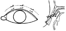 上睑提肌缩短和徙前术图片