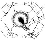 周边虹膜切除术图片