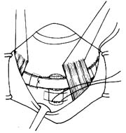 巩膜扣带术图片