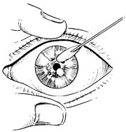 角膜异物取出术图片