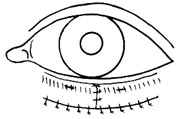 眼睑前层缺损的修复图片