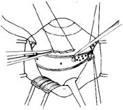 视网膜裂孔电凝术图片