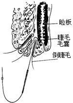 倒睫电解（冷冻）术图片