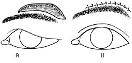 眉下垂手术图片