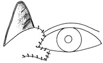 眦部缺损的修复图片