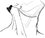 咽侧、颈侧肿瘤摘除术图片