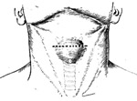 舌甲囊肿、瘘管摘除术图片