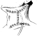 颈淋巴结切除术图片