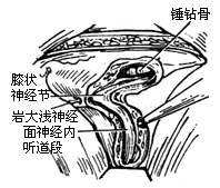 面神经手术图片