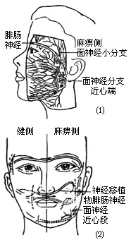 面神经手术图片