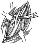 颈外动脉结扎术图片