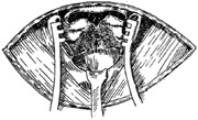 喉裂开途径杓状软骨切除术图片