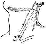 颈部腮源性囊肿及瘘管摘除术图片