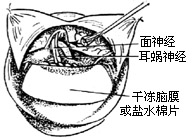 听神经瘤手术图片