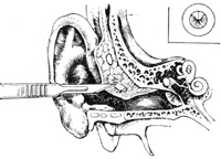 外耳道疖切开术图片