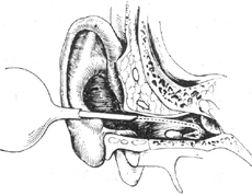 外耳道异物取出术图片