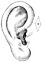 耳前瘘管摘除术图片