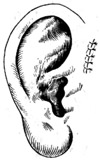 耳前瘘管摘除术图片