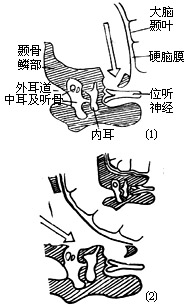 眩晕手术图片