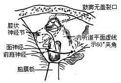 眩晕手术图片