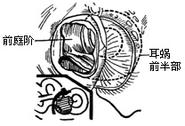 眩晕手术图片