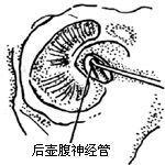 眩晕手术图片