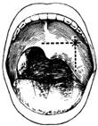 扁桃体周围脓肿切开引流术图片