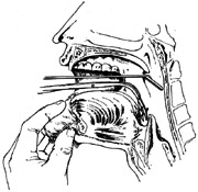 咽部异物取出术图片