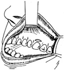 口腔-上颌窦瘘管修补术图片