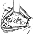 口腔-上颌窦瘘管修补术图片