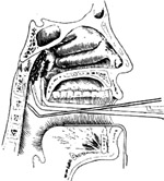 鼻咽部活组织检查术图片