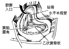 单纯乳突凿开术图片