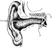 中耳肉芽摘除术图片