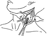 咽后脓肿切开引流术图片