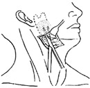 咽侧脓肿切开引流术图片