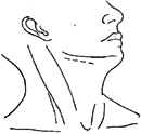 咽侧脓肿切开引流术图片
